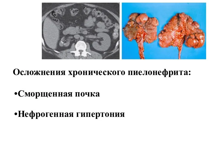 Сморщенная почка Нефрогенная гипертония Осложнения хронического пиелонефрита: