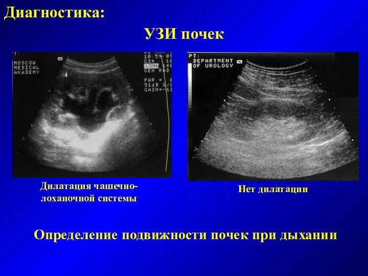 Диагностика: УЗИ почек Дилатация чашечно-лоханочной системы Нет дилатации Определение подвижности почек при дыхании