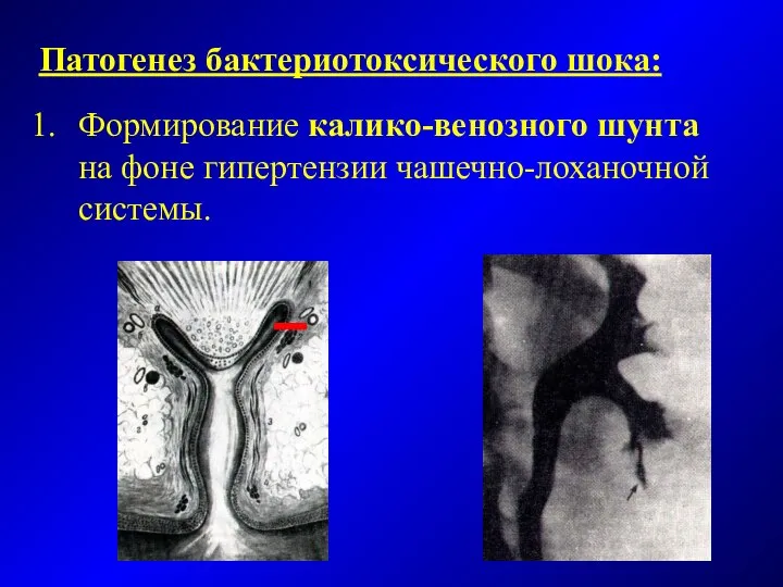 Патогенез бактериотоксического шока: Формирование калико-венозного шунта на фоне гипертензии чашечно-лоханочной системы.