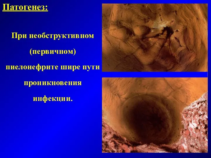 Патогенез: При необструктивном (первичном) пиелонефрите шире пути проникновения инфекции.