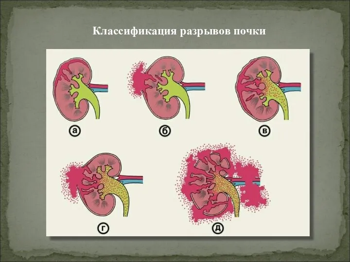 Классификация разрывов почки