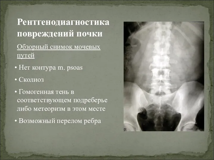 Рентгенодиагностика повреждений почки Обзорный снимок мочевых путей Нет контура m. psoas