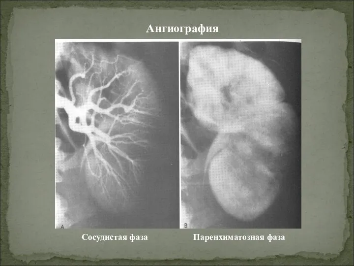 Ангиография Сосудистая фаза Паренхиматозная фаза