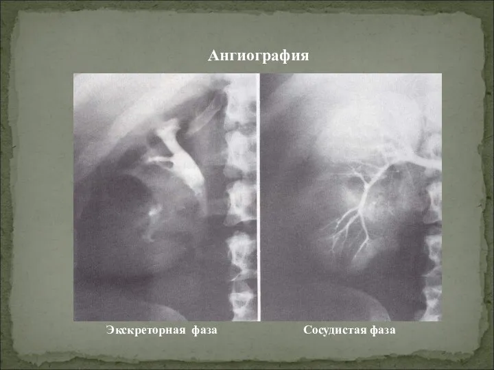 Ангиография Экскреторная фаза Сосудистая фаза