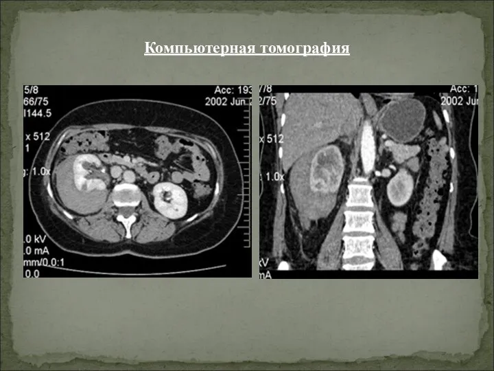 Компьютерная томография