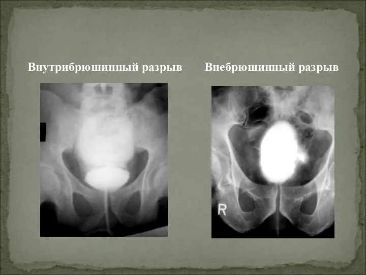 Внутрибрюшинный разрыв Внебрюшинный разрыв