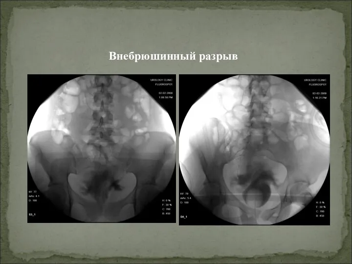 Внебрюшинный разрыв