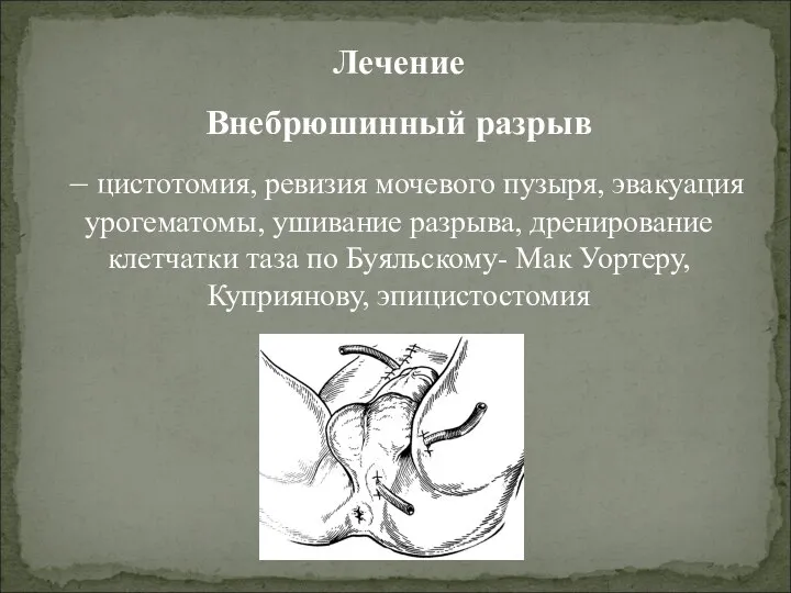 Лечение Внебрюшинный разрыв – цистотомия, ревизия мочевого пузыря, эвакуация урогематомы, ушивание