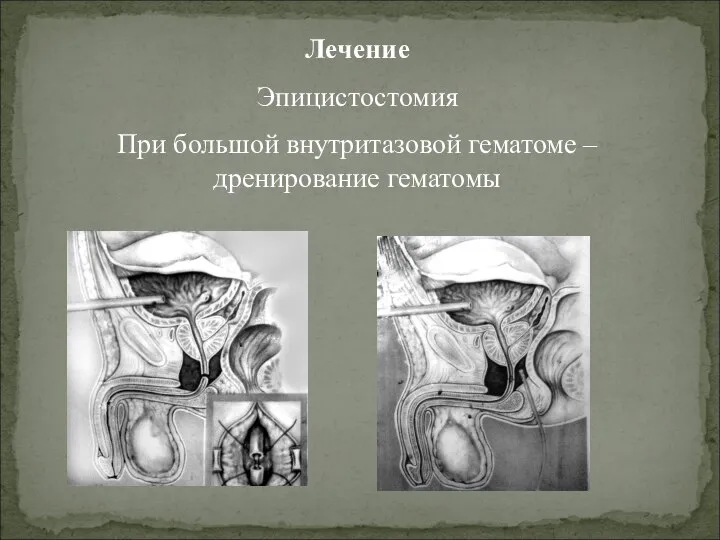 Лечение Эпицистостомия При большой внутритазовой гематоме – дренирование гематомы