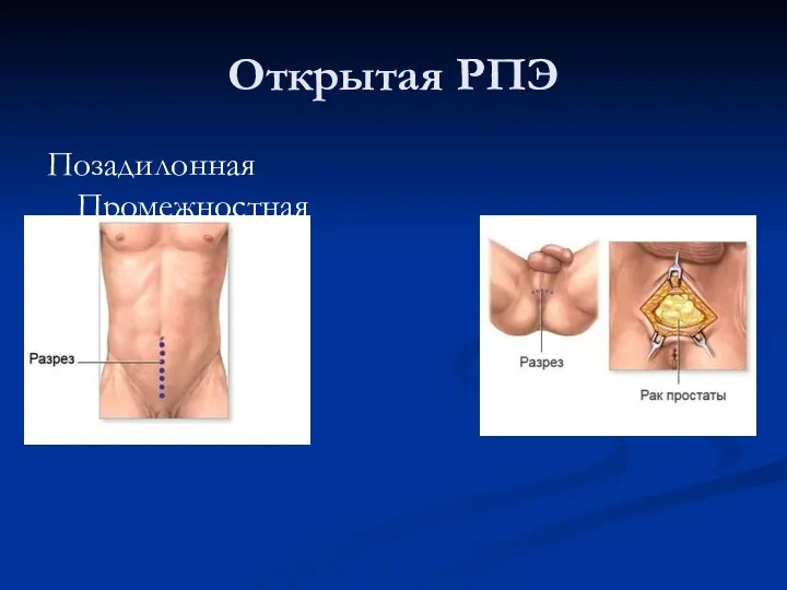 Открытая РПЭ Позадилонная Промежностная