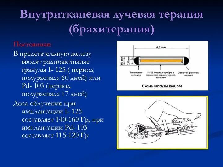 Внутритканевая лучевая терапия (брахитерапия) Постоянная: В предстательную железу вводят радиоактивные гранулы