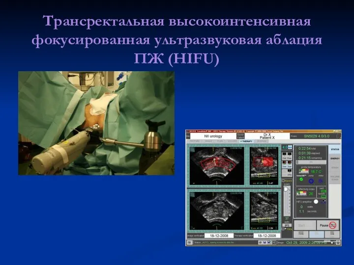 Трансректальная высокоинтенсивная фокусированная ультразвуковая аблация ПЖ (HIFU)