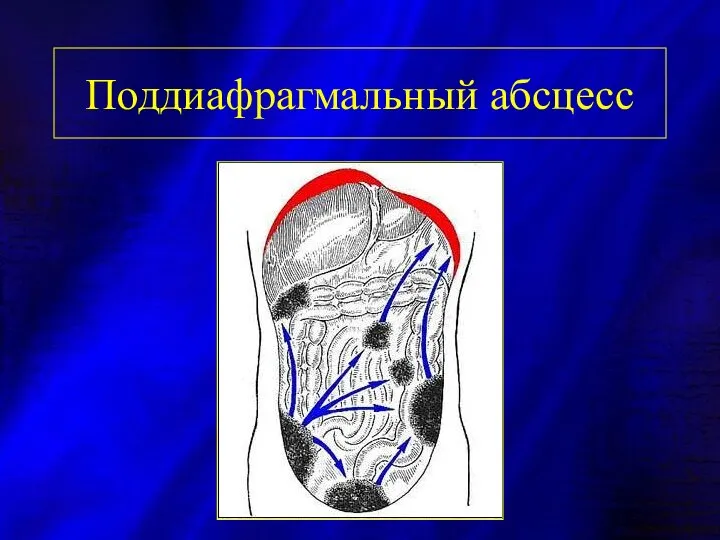 Поддиафрагмальный абсцесс