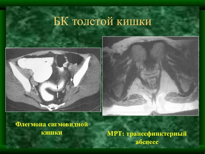 БК толстой кишки Флегмона сигмовидной кишки МРТ: транссфинктерный абсцесс