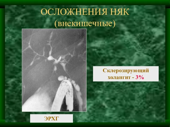 ОСЛОЖНЕНИЯ НЯК (внекишечные) ЭРХГ Склерозирующий холангит - 3%