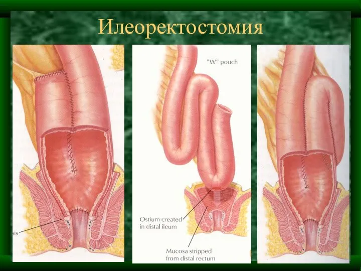 Илеоректостомия