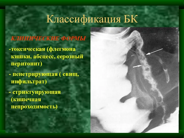 Классификация БК КЛИНИЧЕСКИЕ ФОРМЫ токсическая (флегмона кишки, абсцесс, серозный перитонит) пенетрирующая