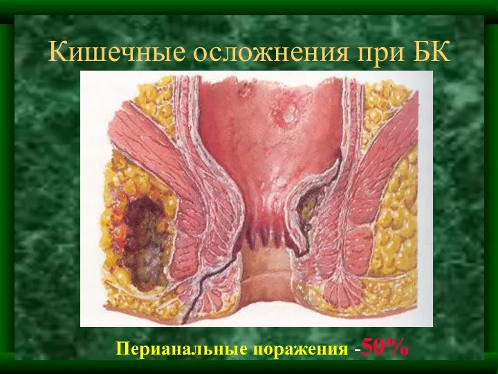 Кишечные осложнения при БК Перианальные поражения -50%