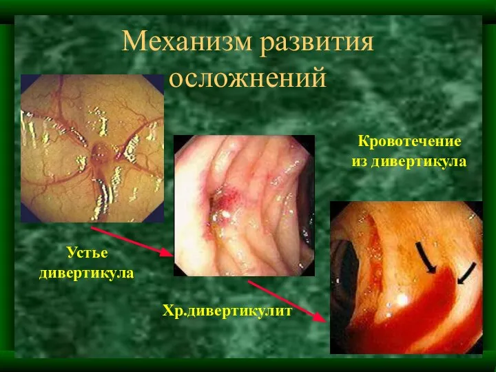 Механизм развития осложнений Устье дивертикула Хр.дивертикулит Кровотечение из дивертикула