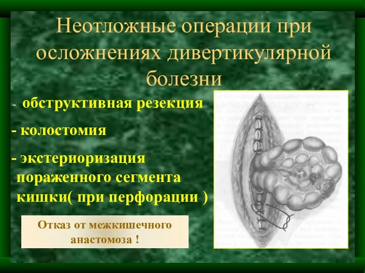 Неотложные операции при осложнениях дивертикулярной болезни обструктивная резекция колостомия экстериоризация пораженного