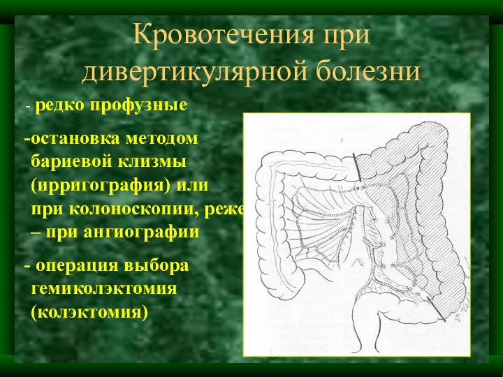 Кровотечения при дивертикулярной болезни редко профузные остановка методом бариевой клизмы (ирригография)