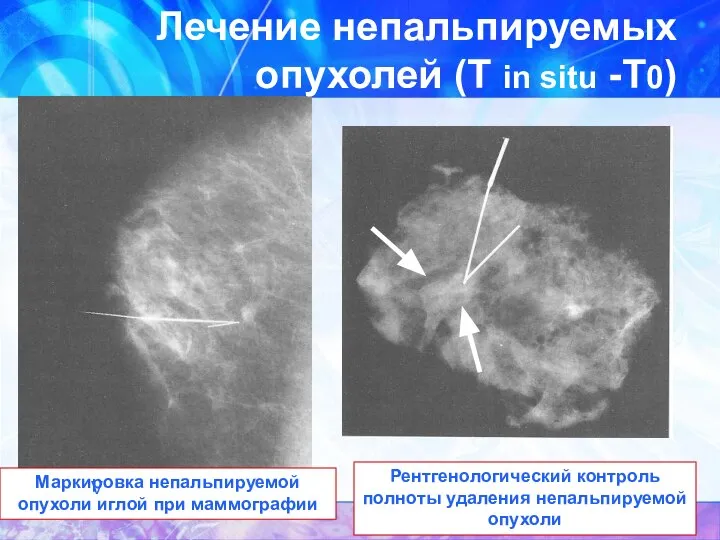 Маркировка непальпируемой опухоли иглой при маммографии V Рентгенологический контроль полноты удаления