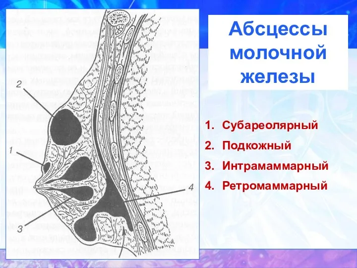 Абсцессы молочной железы Субареолярный Подкожный Интрамаммарный Ретромаммарный