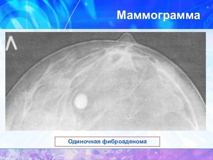 Маммограмма Одиночная фиброаденома