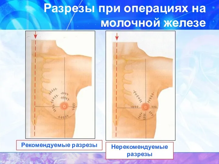 Разрезы при операциях на молочной железе Рекомендуемые разрезы Нерекомендуемые разрезы