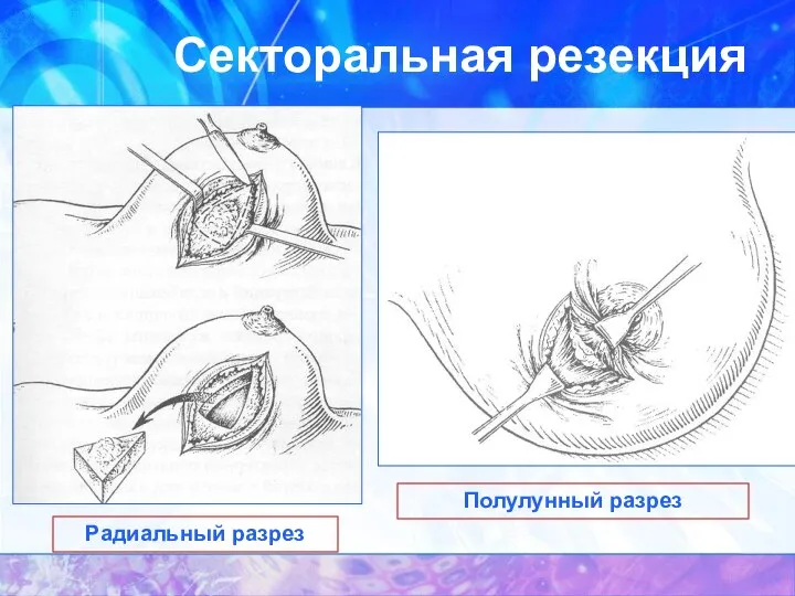 Секторальная резекция Радиальный разрез Полулунный разрез