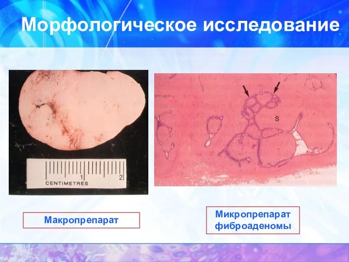 Морфологическое исследование Макропрепарат Микропрепарат фиброаденомы