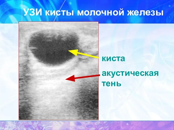 УЗИ кисты молочной железы киста акустическая тень