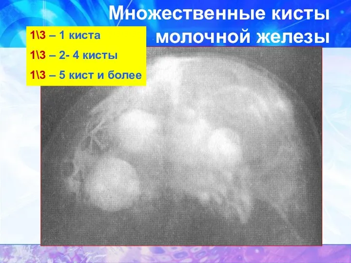 Множественные кисты молочной железы 1\3 – 1 киста 1\3 – 2-