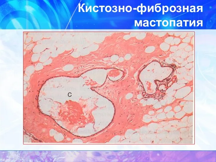 Кистозно-фиброзная мастопатия