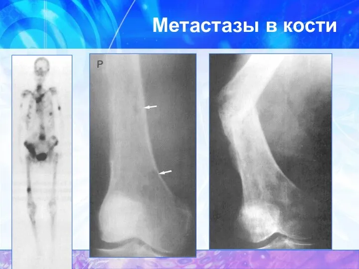 Метастазы в кости