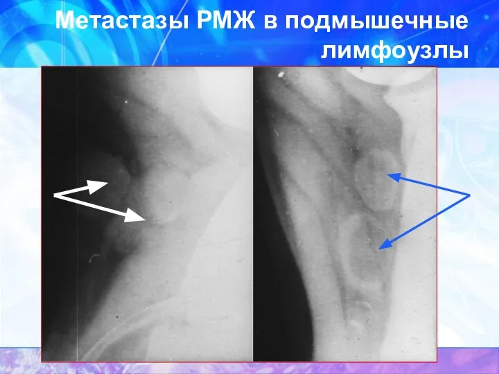 Метастазы РМЖ в подмышечные лимфоузлы