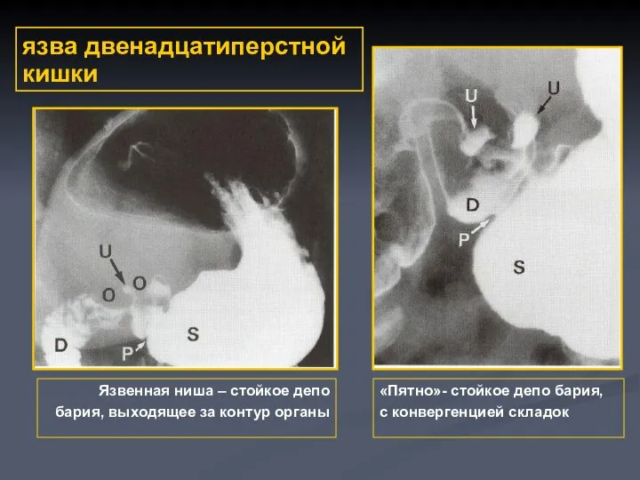 язва двенадцатиперстной кишки «Пятно»- стойкое депо бария, с конвергенцией складок Язвенная