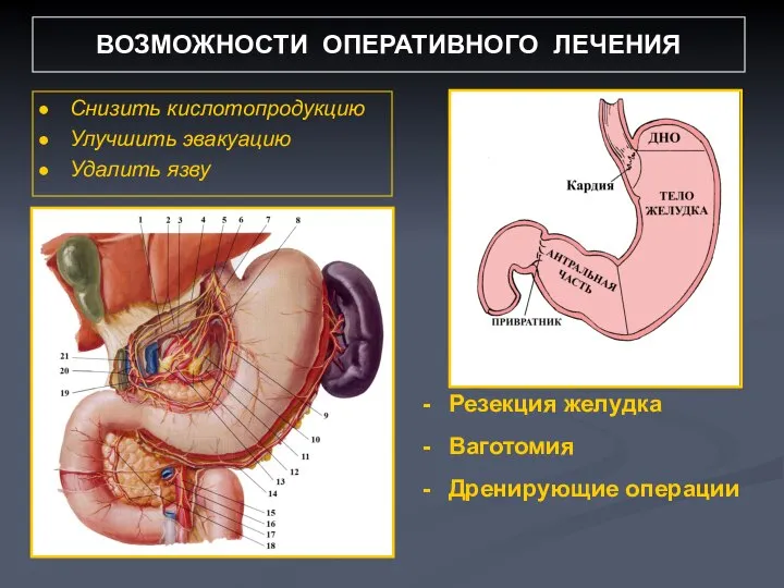 ВОЗМОЖНОСТИ ОПЕРАТИВНОГО ЛЕЧЕНИЯ Снизить кислотопродукцию Улучшить эвакуацию Удалить язву Резекция желудка Ваготомия Дренирующие операции