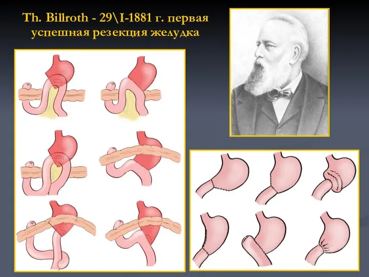 Th. Billroth - 29\I-1881 г. первая успешная резекция желудка