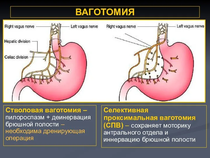 ВАГОТОМИЯ Стволовая ваготомия – пилороспазм + деинервация брюшной полости – необходима