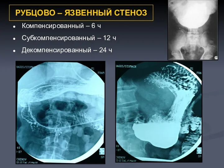 РУБЦОВО – ЯЗВЕННЫЙ СТЕНОЗ Компенсированный – 6 ч Субкомпенсированный – 12 ч Декомпенсированный – 24 ч