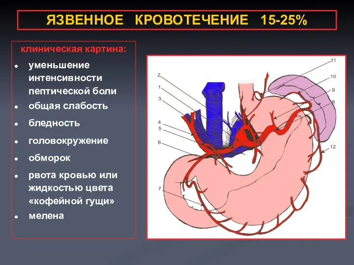 ЯЗВЕННОЕ КРОВОТЕЧЕНИЕ 15-25% клиническая картина: уменьшение интенсивности пептической боли общая слабость