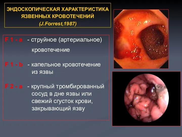 ЭНДОСКОПИЧЕСКАЯ ХАРАКТЕРИСТИКА ЯЗВЕННЫХ КРОВОТЕЧЕНИЙ (J.Forrest,1987) F 1 - а - струйное