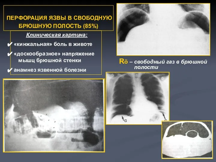 ПЕРФОРАЦИЯ ЯЗВЫ В СВОБОДНУЮ БРЮШНУЮ ПОЛОСТЬ (85%) Rö – свободный газ