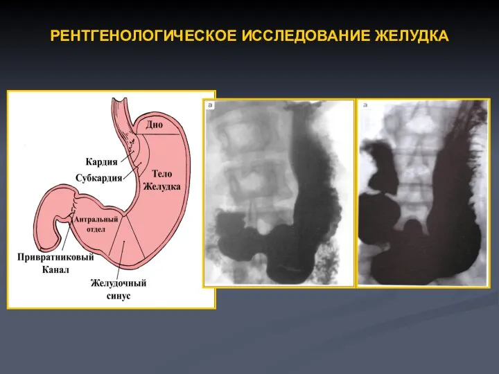 РЕНТГЕНОЛОГИЧЕСКОЕ ИССЛЕДОВАНИЕ ЖЕЛУДКА