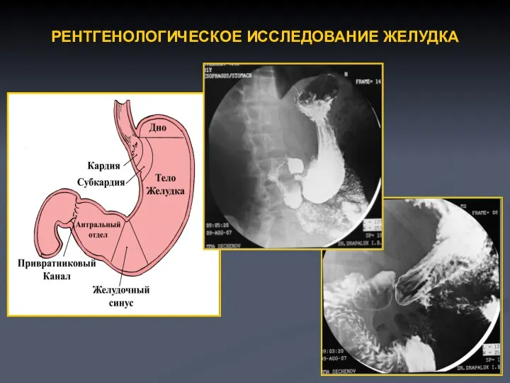 РЕНТГЕНОЛОГИЧЕСКОЕ ИССЛЕДОВАНИЕ ЖЕЛУДКА