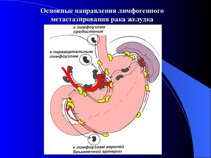 Основные направления лимфогенного метастазирования рака желудка