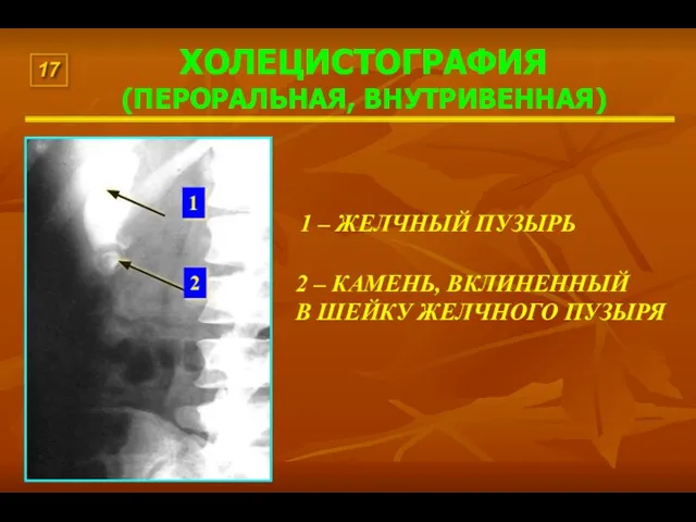 ХОЛЕЦИСТОГРАФИЯ (ПЕРОРАЛЬНАЯ, ВНУТРИВЕННАЯ) 1 – ЖЕЛЧНЫЙ ПУЗЫРЬ 2 – КАМЕНЬ, ВКЛИНЕННЫЙ В ШЕЙКУ ЖЕЛЧНОГО ПУЗЫРЯ 17