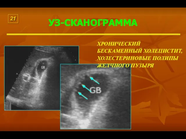 УЗ-СКАНОГРАММА ХРОНИЧЕСКИЙ БЕСКАМЕННЫЙ ХОЛЕЦИСТИТ, ХОЛЕСТЕРИНОВЫЕ ПОЛИПЫ ЖЕЛЧНОГО ПУЗЫРЯ 21