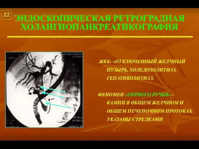 ЭНДОСКОПИЧЕСКАЯ РЕТРОГРАДНАЯ ХОЛАНГИОПАНКРЕАТИКОГРАФИЯ 22 ЖКБ: «ОТКЛЮЧЕННЫЙ ЖЕЛЧНЫЙ ПУЗЫРЬ, ХОЛЕДОХОЛИТИАЗ, ГЕПАТИКОЛИТИАЗ. ФЕНОМЕН